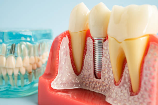 Best Dental Implants  in USA